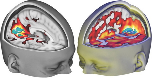 Povečana možganska aktivnost na LSD v primerjavi s placebom.
