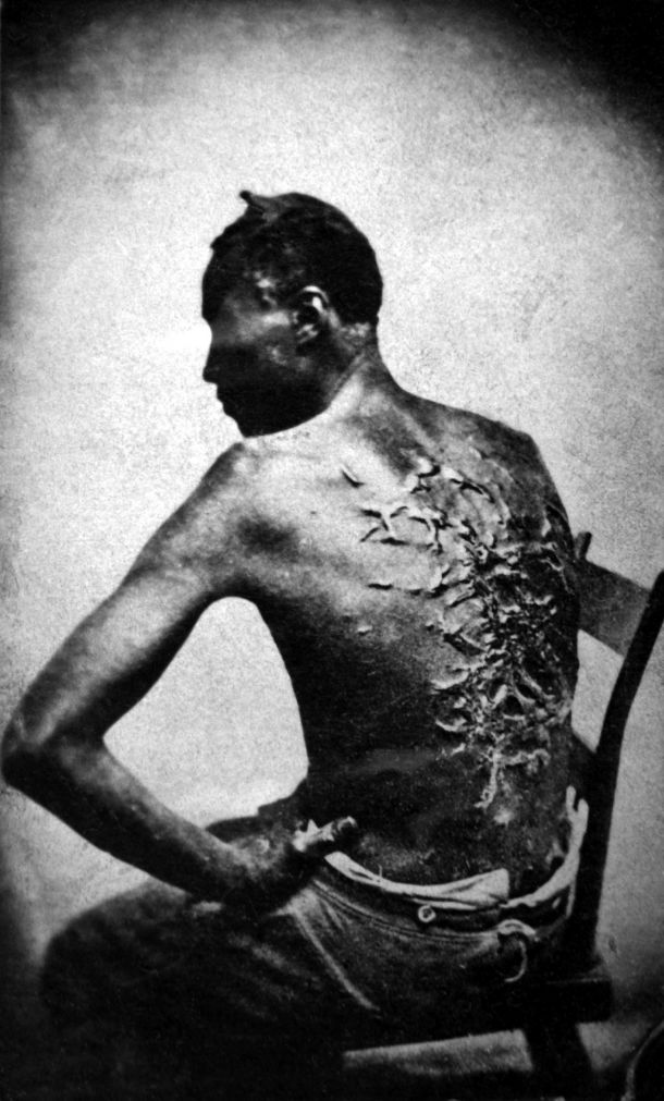 Scars of a whipped Mississippi slave, photo taken (April 2, 1863, Baton Rouge, Louisiana, USA. Original caption: Overseer Artayou Carrier whipped me. I was two months in bed sore from the whipping. My master come after I was whipped; he discharged the overseer. The very words of poor Peter, taken as he sat for his picture.